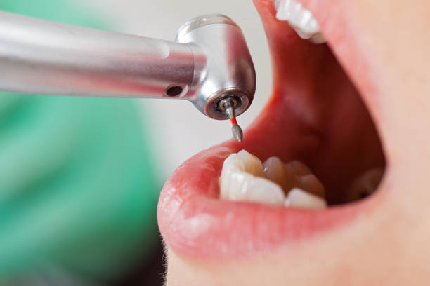Best Emergency Dental Care for Abscessed Tooth in Rafter J Ranch, WY